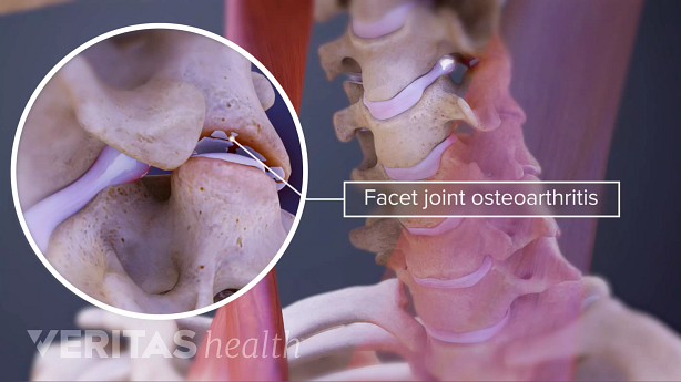 Medical illustration showing facet joint arthritis.