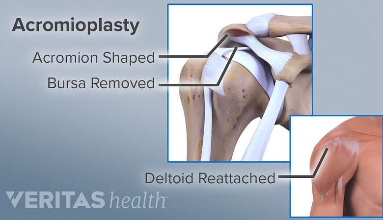 Anatomy of an acromioplasty.