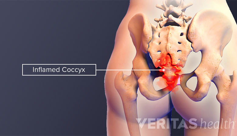 Illustration showing poterior view of hips and pelvis with coccyx highlighted in red.