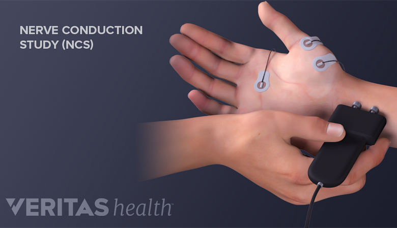 Illustration showing a hand with some electrodes attached performing nerve conduction study.