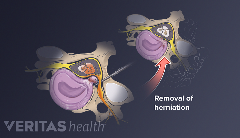 Illustration showing removal of herniated disc.