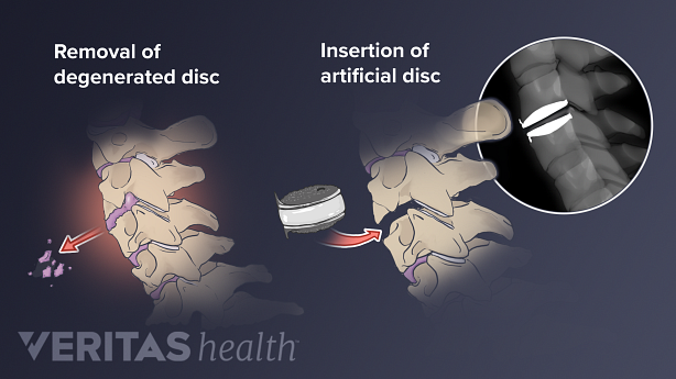 Ilustración de dos partes que muestra la extracción de una hernia de disco y la inserción de una artificial.