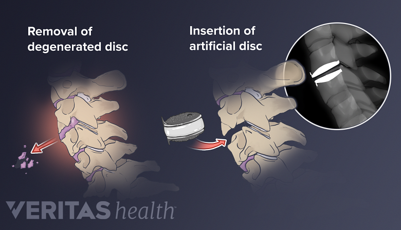 Two-part illustration showing the removal of a herniated disc and the insertion of an artificial one.