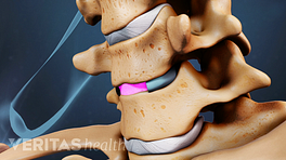 Anterior view of vertebrae showing artificial disc.