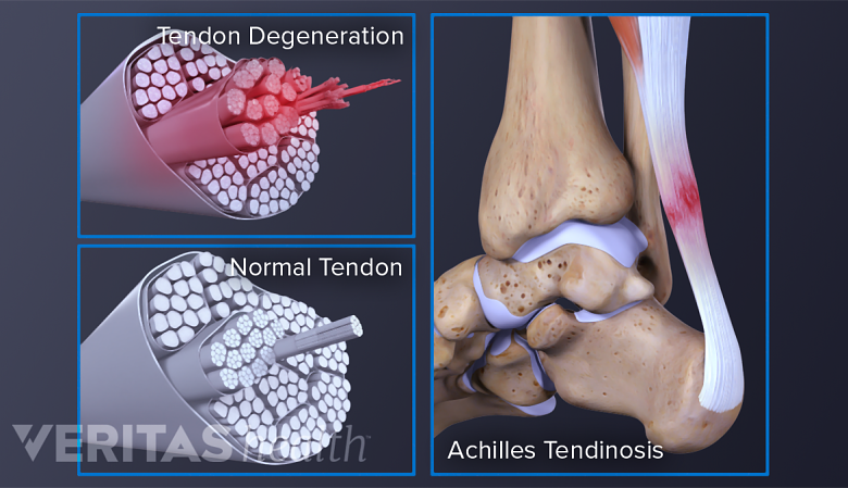 Illustration showing Tendon degeneration, normal tendon and achilles tendinosis.