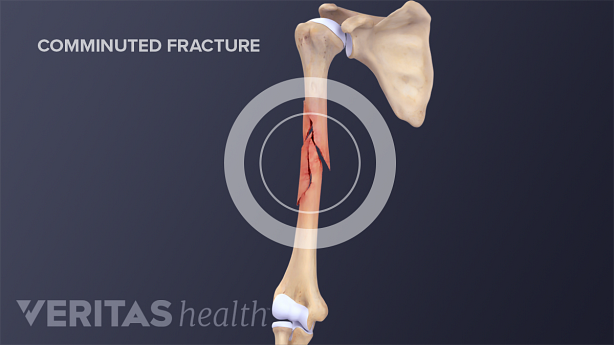 Skeletal bones of the upper shoulder showing a comminuted fracture in the humerus.