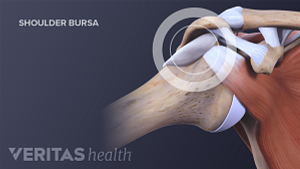 Medical illustration showing shoulder bursa. Clavical, acromion, coracoid process and the humerus are labeled.