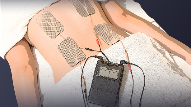 Una imagen que muestra los electrodos del dispositivo TEN en el músculo de la espalda.