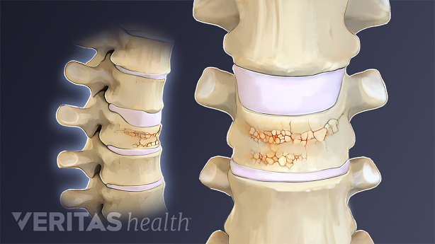 Una ilustración que muestra una fractura por compresión en la vértebra.