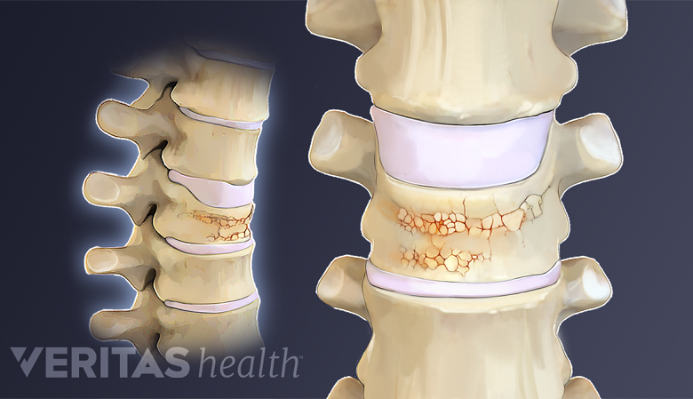 Illustration showing front view and lateral view of vertebral compression fracture.