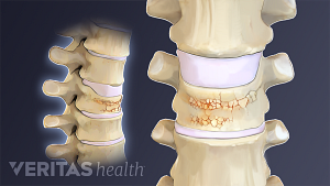 Close up medical illustration of a vertebrae with a compression fracture