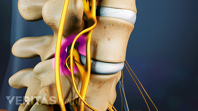 Lumbar Spinal Stenosis Causes and Diagnosis