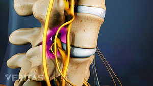 Vista de perfil de la columna cervical que causa compresión de la médula espinal.