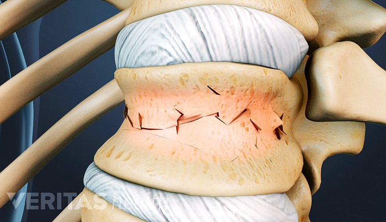 Illustration showing fractured vertebral spine.