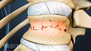 Compression fracture in a thoracic vertebra