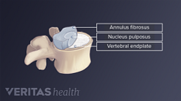 Illustration of anatomy of lumbar vertebra labelling nucleus pulpous, annulus fibrosis, and vertebral end plate.