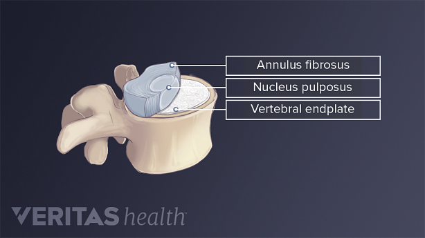 Cross sectional view of a lumbar vertebra and disc.