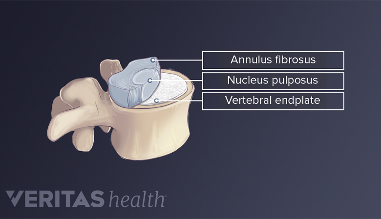 Illustration showing anatomy of lumbar vertebrae with nucleus pulposus, annulus fibrosis, cartilaginous endplates.