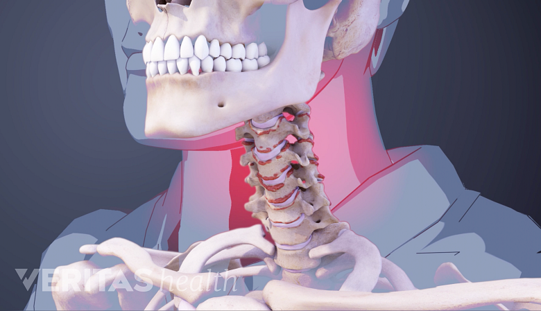 Illustration showing cervical vertebrae with bone spurs andred highlight on the neck.