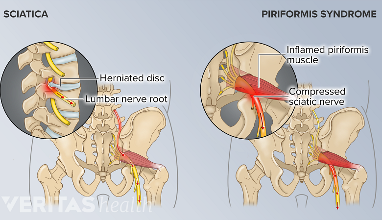 Points of origin shown from the posterior view of sciatica vs piriformis syndrome