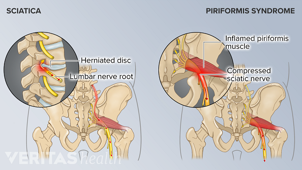 A herniated disc causing sciatica and inflamed piriformis muscle causing piriformis syndrome.