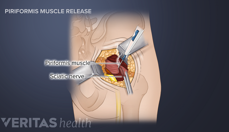 An illustration showing piriformis surgery.