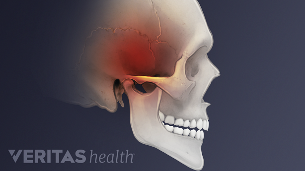 Illustration showing temporo-mandibular joint headache.