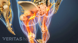 Ilustración médica de la parte inferior del cuerpo que muestra huesos y nervios. El nervio ciático está resaltado en rojo, lo que indica dolor, entumecimiento u hormigueo.