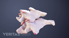 Two cervical vertebrae with bone spurs