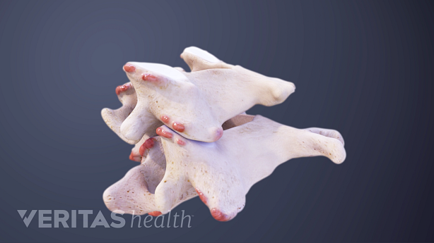 Posterior view of two cervical vertebrae with bone spurs