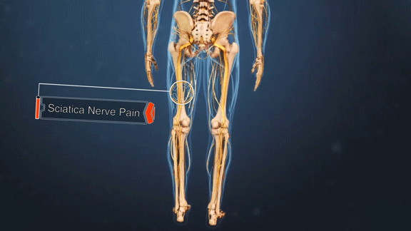 Posterior view of the lower body showing sciatica nerve pain traveling down the left leg.