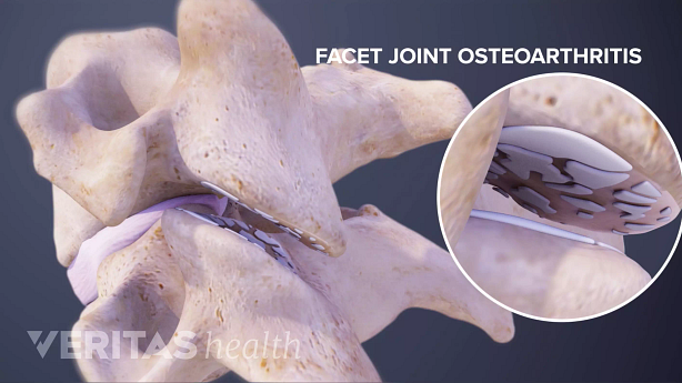 Posterior view 3D image depicting facet joint osteoarthritis.