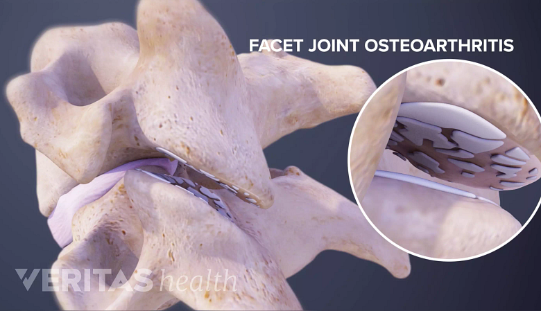 Illustration showing cervoical vertebrae with facet joints and a inset showing osteoarthritis.