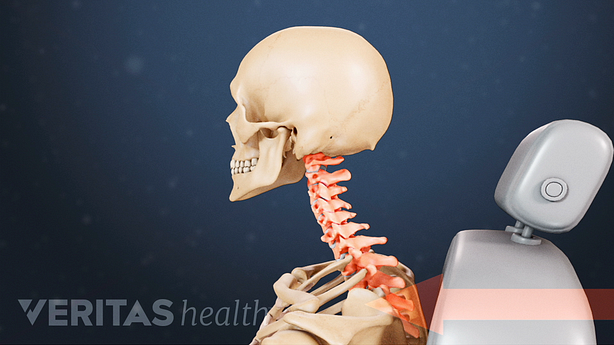 Illustration showing whiplash injury.
