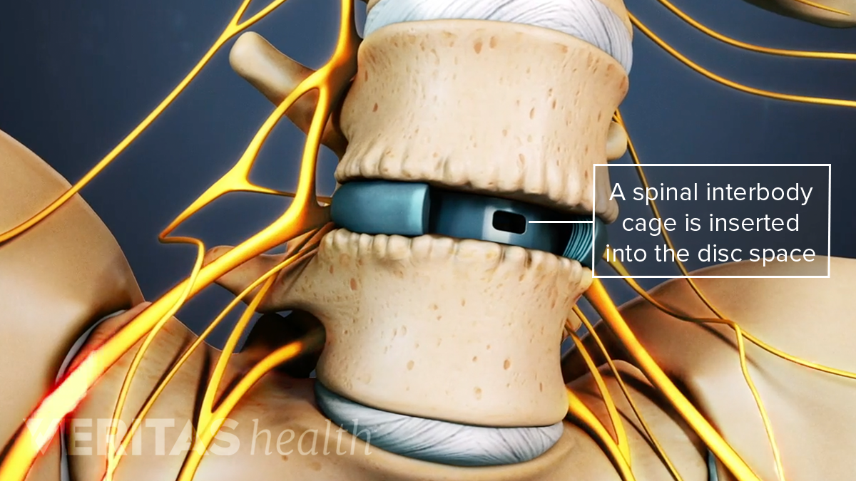 The Multilevel Spinal Fusion Surgery | Spine-health