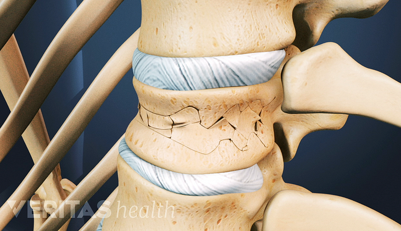 Illustration showing vertebra with fracture.