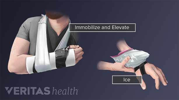 Wrist in a sling to immobilize and elevate and someone icing wrist with a brace