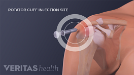 Injection for a rotator cuff tear