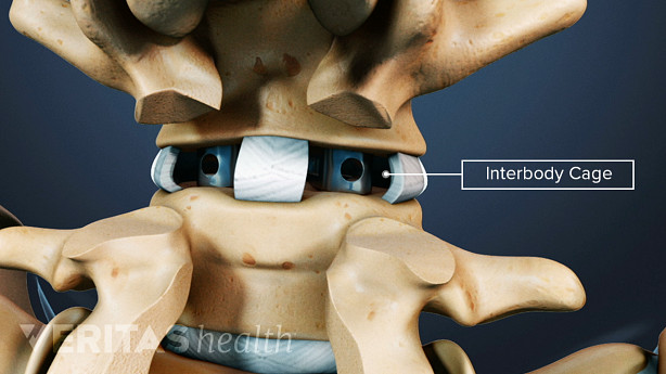 Posterior view of implants in the disc space of the lumbar spine.