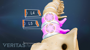 Medical illustration of the spine. The L4 and L5 vertebrae are highlighted.