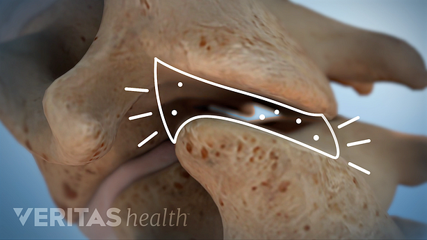 Illustration showing facet joint crepitus.