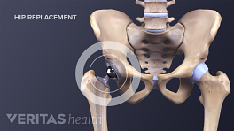 Medical illustration showing the parts of a hip joint replacement