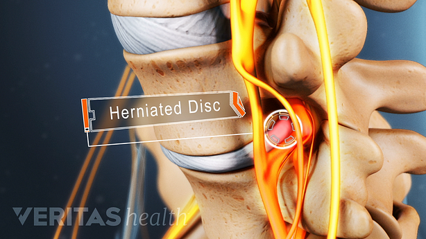 Medical illustration of a herniated disc impinging on a nerve