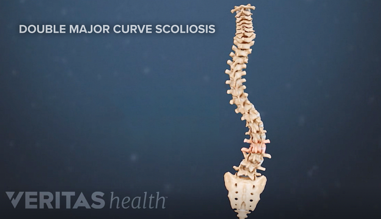 Types of Scoliosis Braces: TLSO, SpineCor, Charleston & Providence
