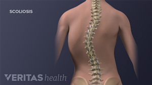 Medical illustration of an adolescent spine with thoracic scoliosis