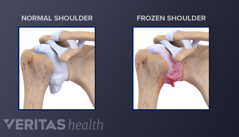 Illustration showing normal shoulder joint and frozen shoulder joint anatomy.