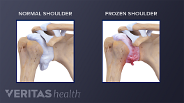 Cross section of normal joint compared to one with frozen shoulder (adhesive capsulitis).