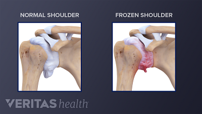 A comparison between a normal shoulder joint and a shoulder joint with adhesive capsulitis