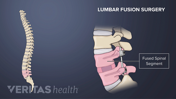 Illustration showing lumbar spine fusion and posterior view of vertebral column.
