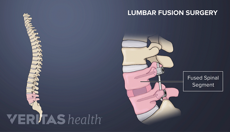 illustration showing vertebral spine and zoomed out fused lumbar vertebra in pink.